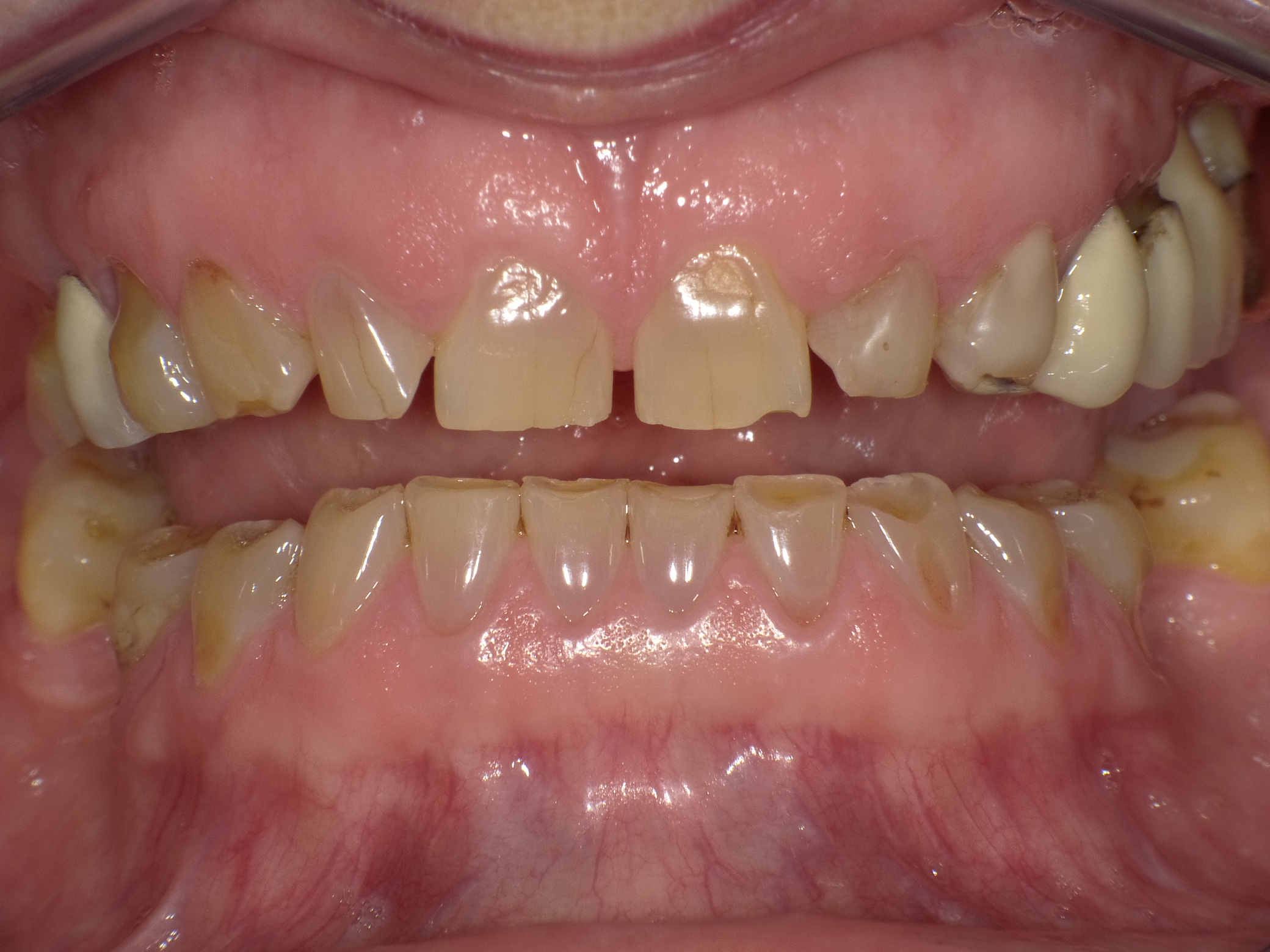 Patientin mit dem Wunsch nach ästhetischer Optimierung der Gesamtsituation